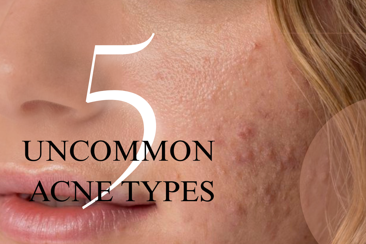 5 Uncommon Acne Types You Might Be Overlooking—and How to Treat Them