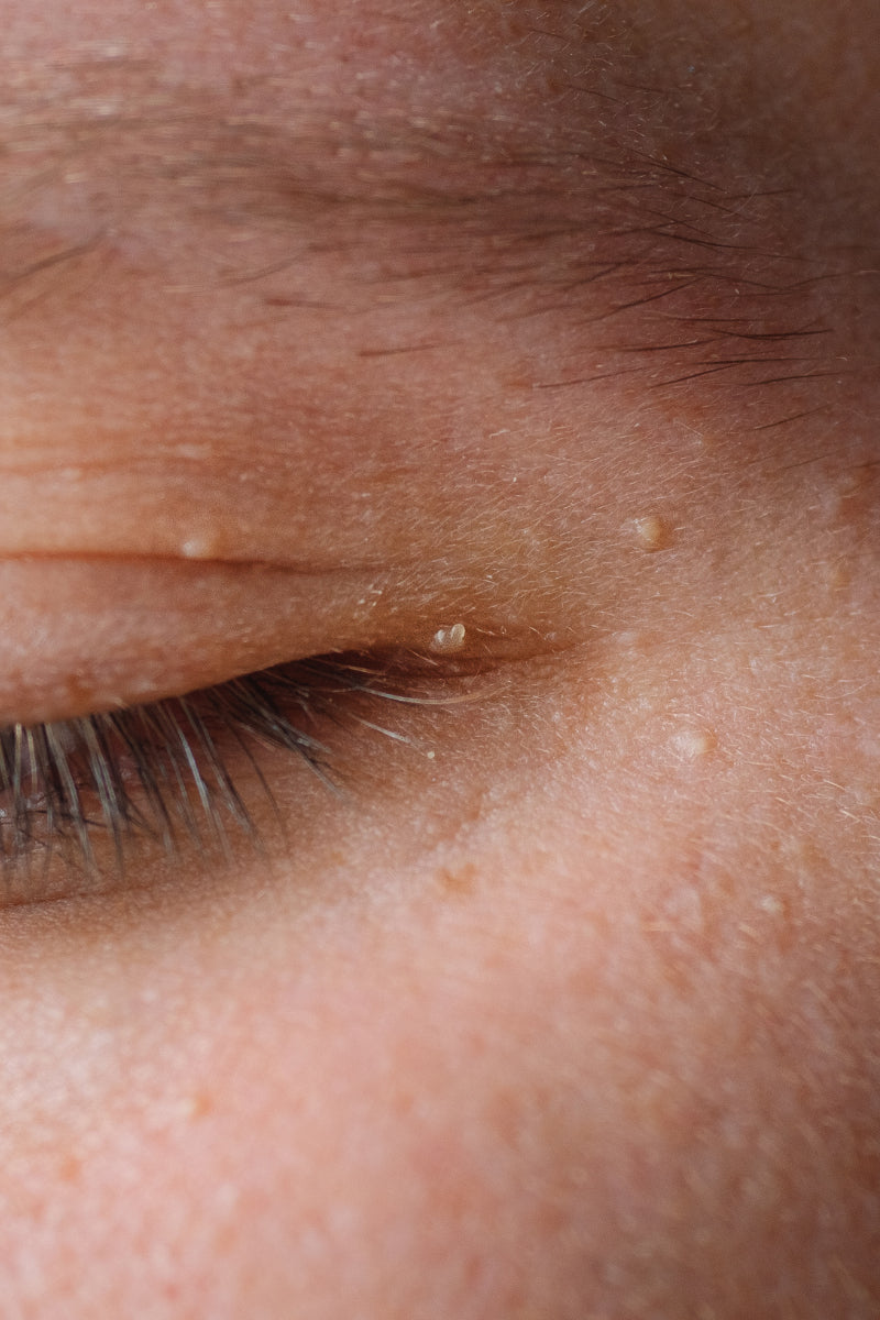 Milia 101: The Breakdown