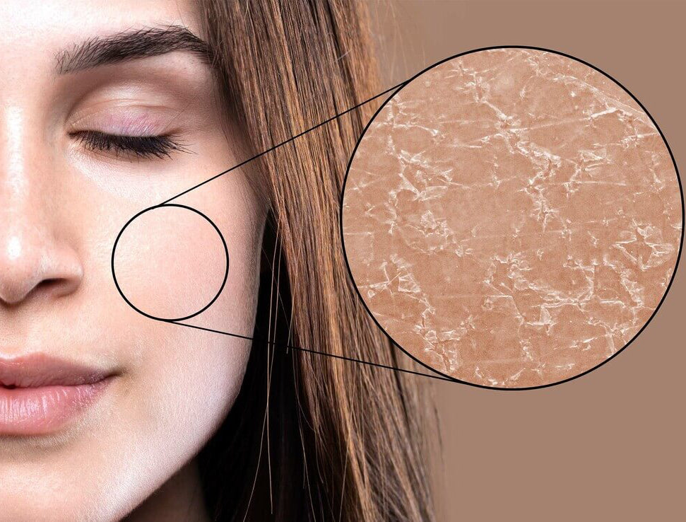 Magnified close-up of dry skin texture on a woman's cheek showing rough and dehydrated facial skin