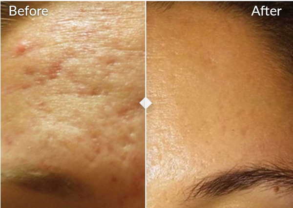 Why is Microneedling So Popular?