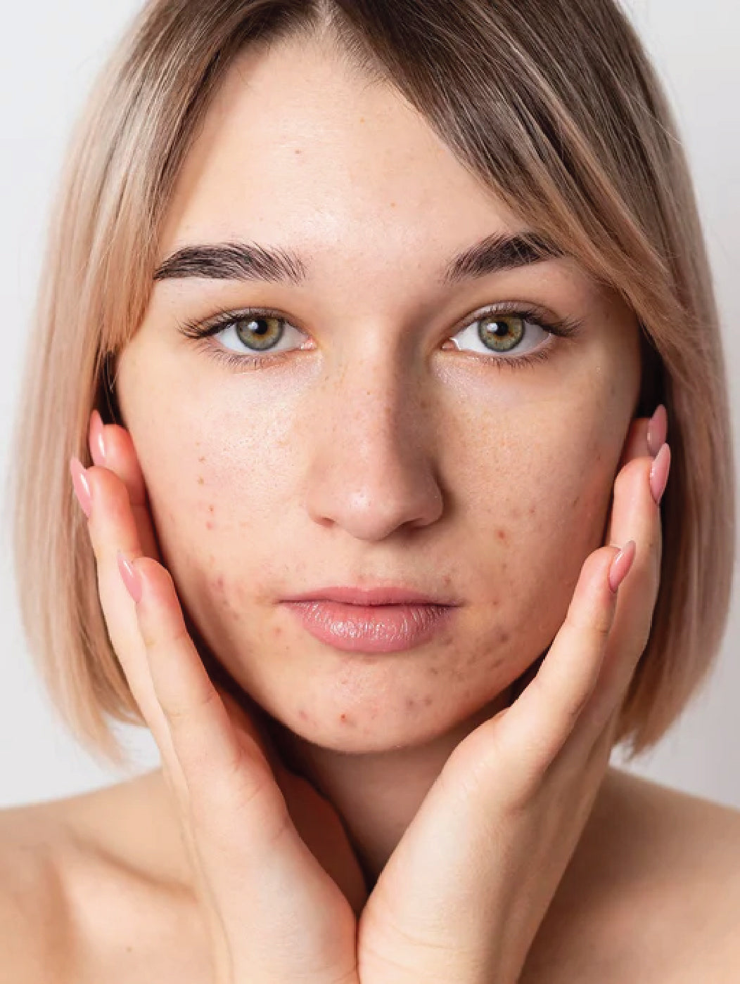 Close-up of a woman with blackheads, pimples, and visible clogged pores, highlighting the effects of excess sebum and acne formation. Featured on Allana Davis Studio.