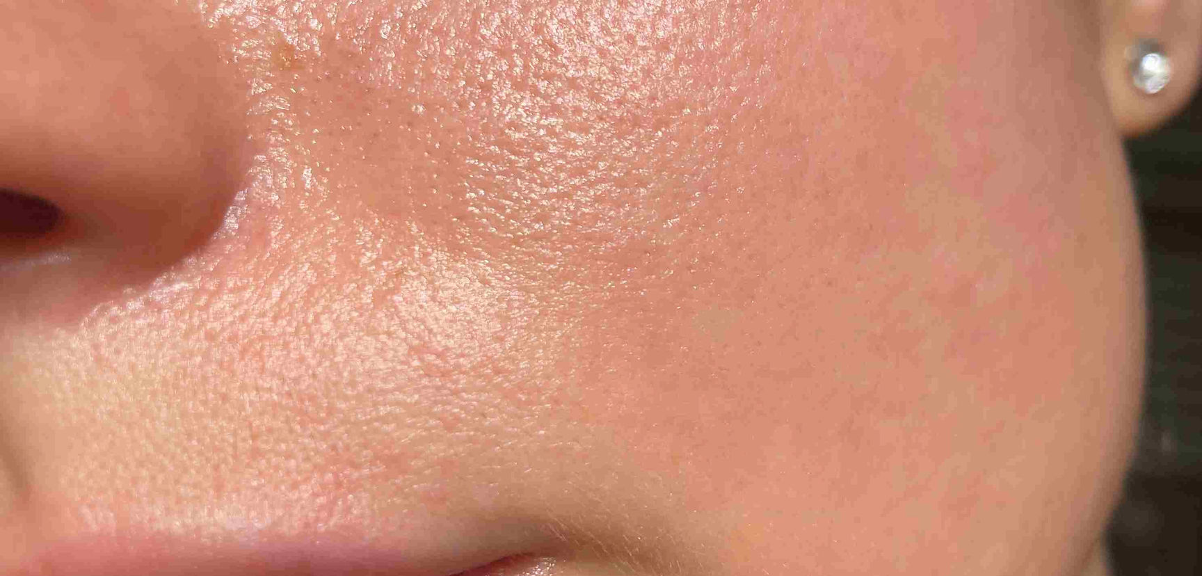 Close-up of skin with enlarged pores and visible texture, highlighting the effects of excess sebum and oiliness. Featured on Allana Davis Studio.