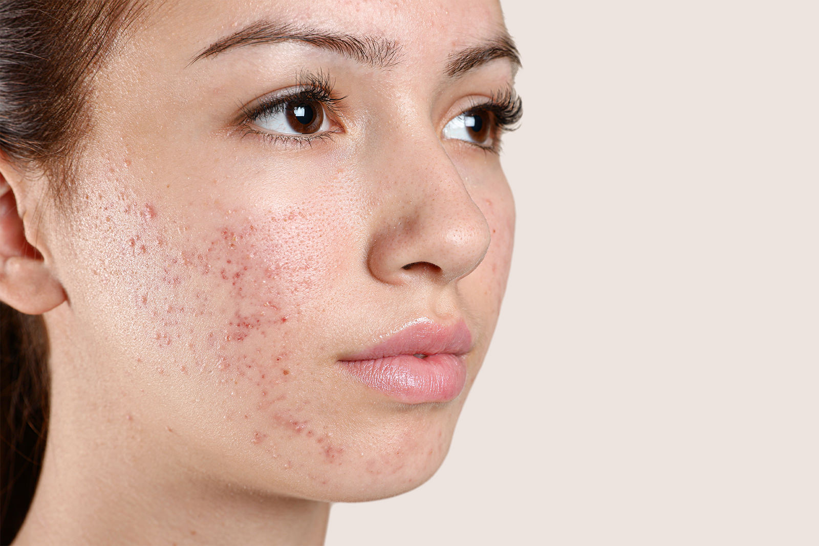 Close-up of a woman with visible excess sebum, acne breakouts, and enlarged pores, demonstrating the effects of oily skin and clogged pores. Featured on Allana Davis Studio.